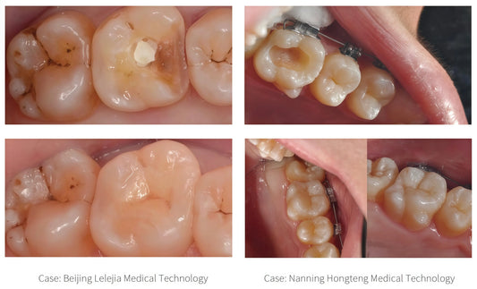 CAD/CAM glass ceramic for fast dental restorations