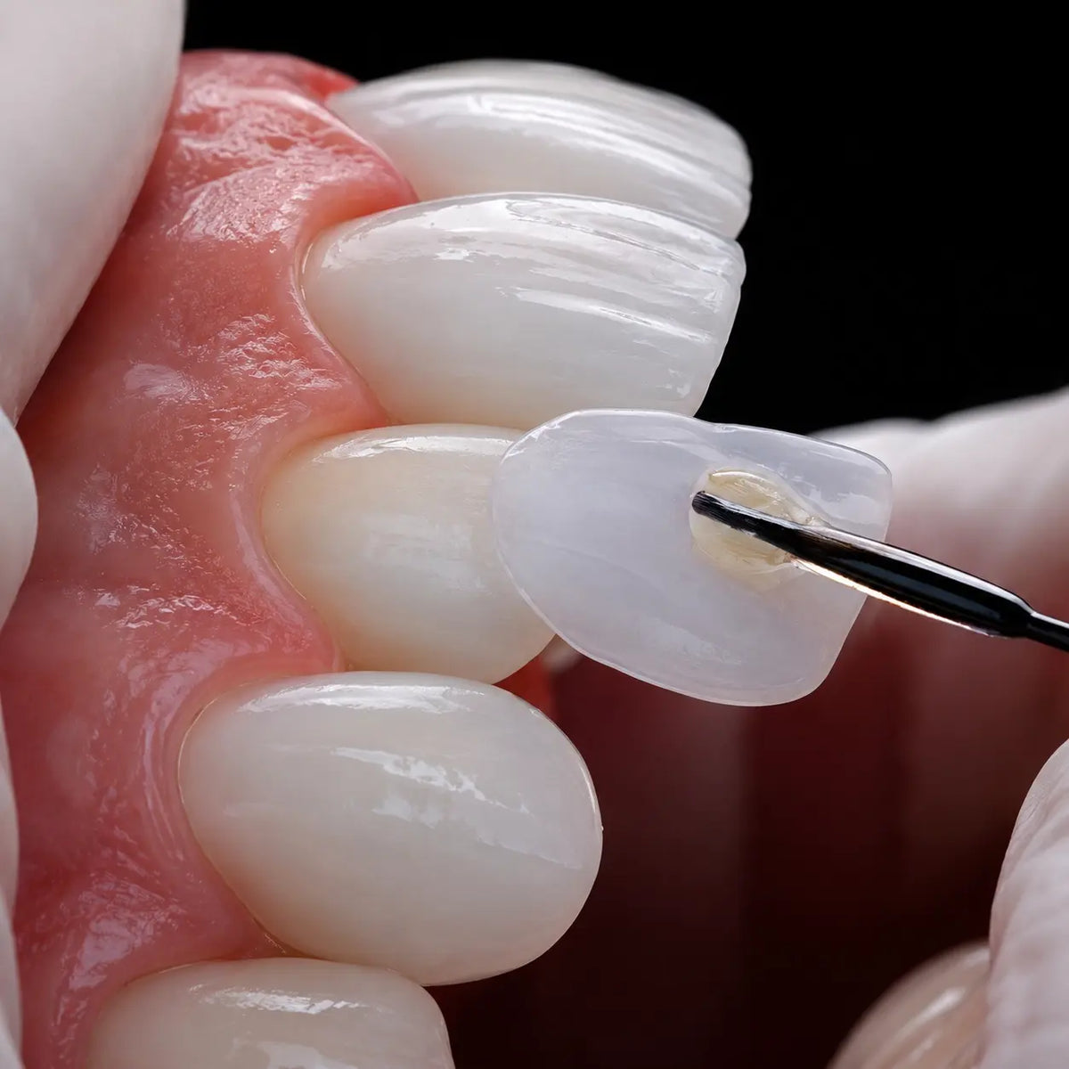 U-ZEE Pro ceramic veneer being positioned on an anterior tooth during the veneer bonding workflow