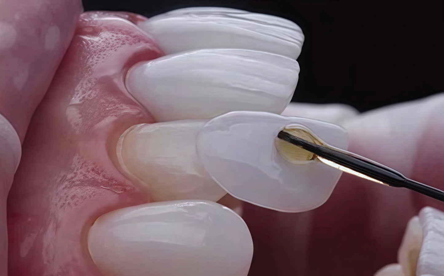 U-ZEE Dazzling veneer material for esthetic restorations