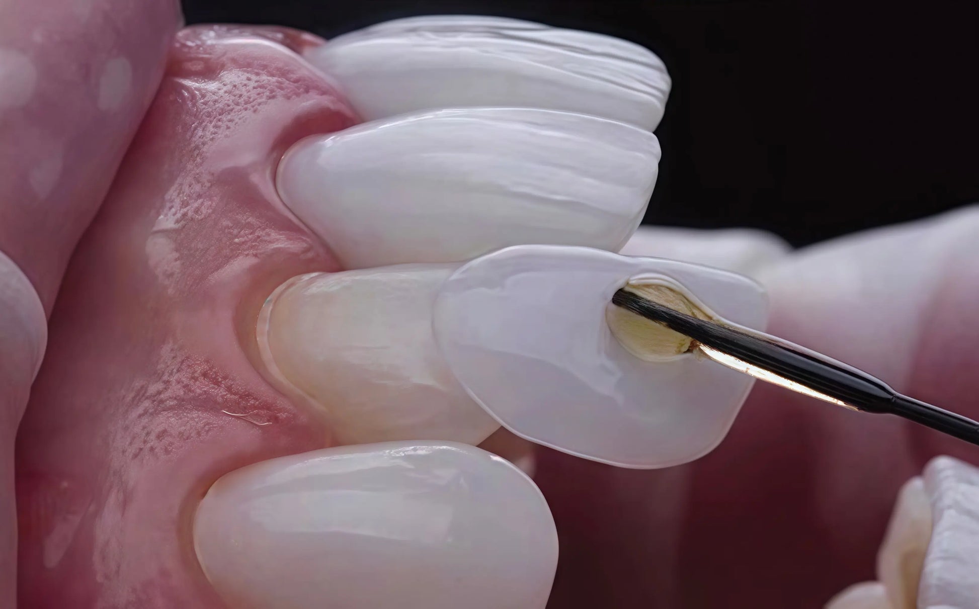 U-ZEE Dazzling veneer material for esthetic restorations