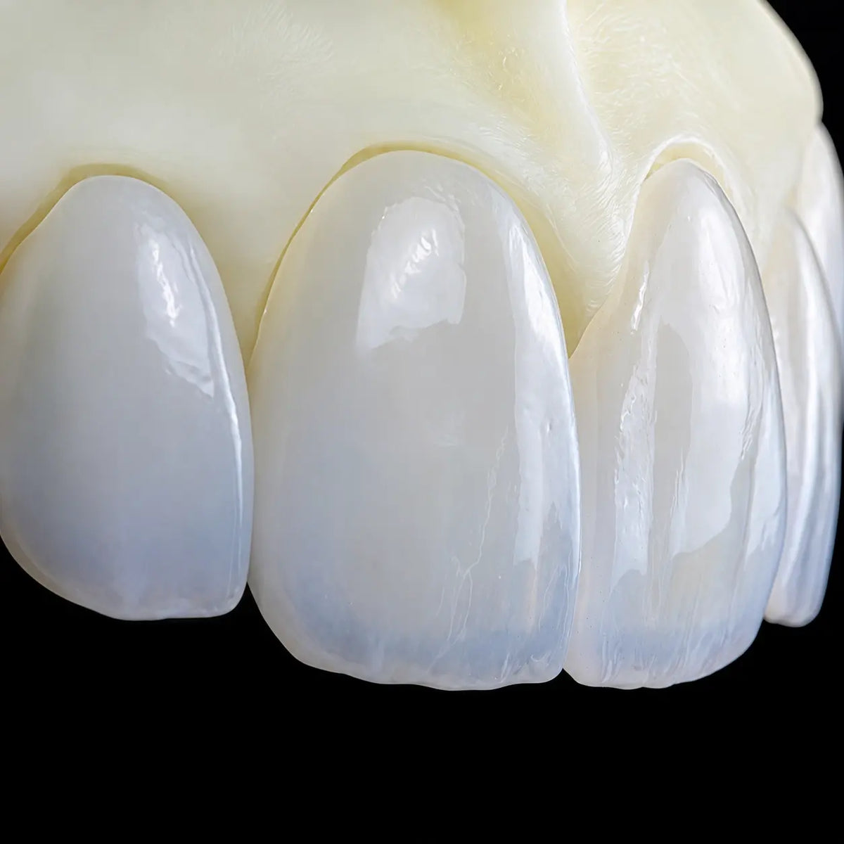 Close-up of anterior veneer restorations made with pressable lithium disilicate glass ceramic