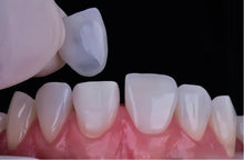 OnePro Dental UT Preshaded zirconia veneer placement showing natural translucency for anterior dental restorations