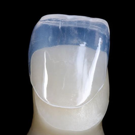 Single tooth restoration example made with pressable lithium disilicate glass ceramic ingot